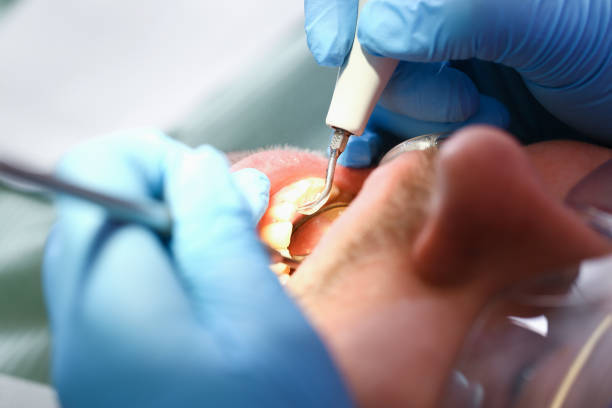 Best Emergency Tooth Extraction in Belle Fourche, SD